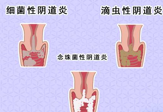 阴道分泌物香蕉福利视频剖析什么是细菌性阴道炎