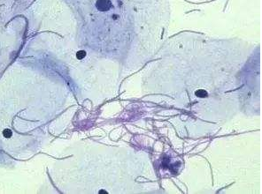 阴道分泌物香蕉福利视频厂家探讨白带清洁度3代表什么意思