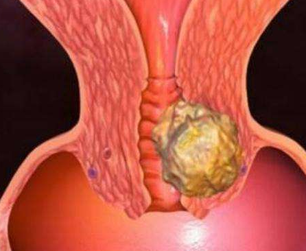 阴道分泌物香蕉福利视频厂家分析阴道分泌物多的原因