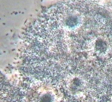 全自动白带香蕉视频免费APP厂家分析线索细胞感染的缘由