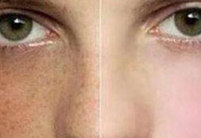 为什么患妇科病的女性脸上更容易长斑 为什么患妇科病的女性脸上更容易长斑