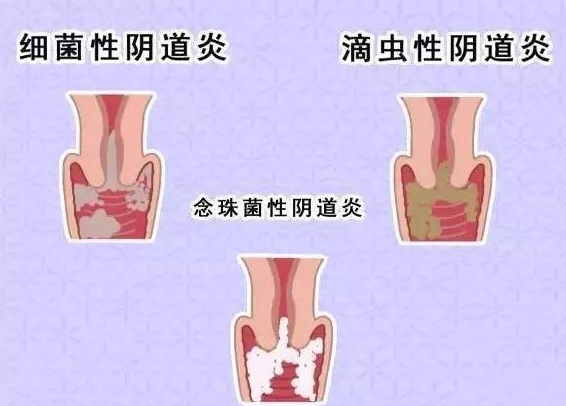 全自动阴道分泌物香蕉福利视频厂家提醒您还在拖延吗，还在等阴道炎自愈吗？
